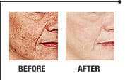 Laser skin rejuvenation result 1