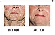 Laser skin rejuvenation result 2
