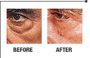 Laser skin rejuvenation result 4