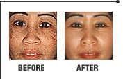 Laser skin rejuvenation result 5