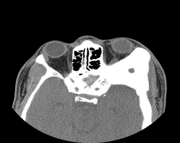 CT of orbital fibrous dysplasia — expanded ground-glass bone