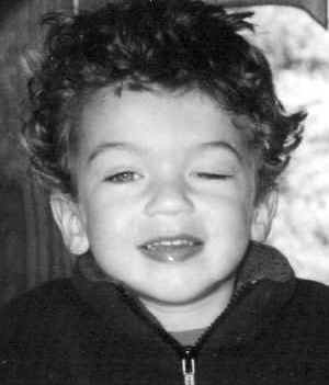 Congenital ptosis pre-operative