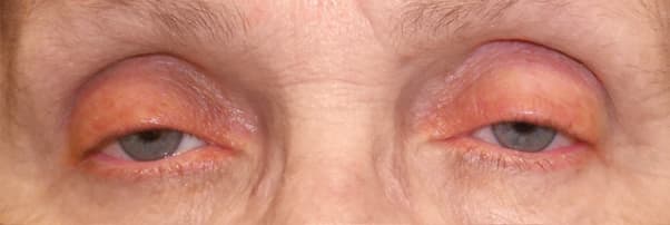 Both upper lids low in an older adult — low margin, high crease