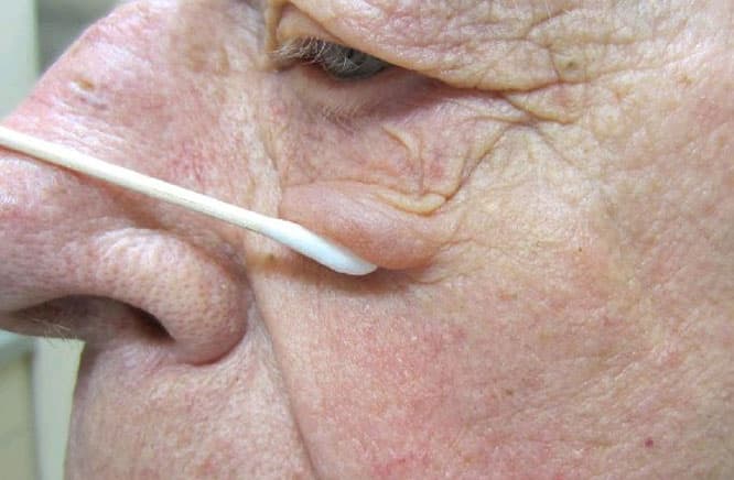 Rosacea — periocular involvement