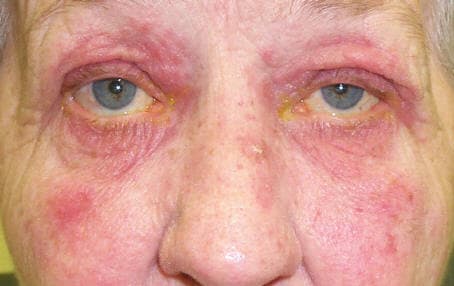 Facial rosacea — erythema and telangiectasias