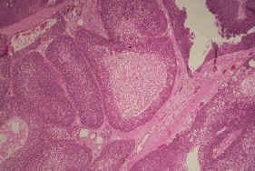 Histology of sebaceous gland carcinoma