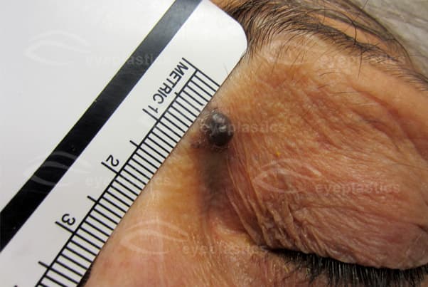 Pigmented basal cell carcinoma of the eyelid