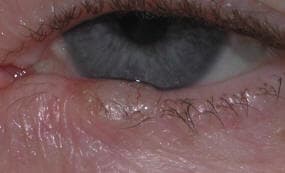 Nodular basal cell carcinoma with pearly translucent border
