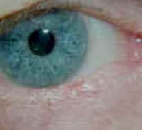 Basal cell carcinoma of the lower eyelid