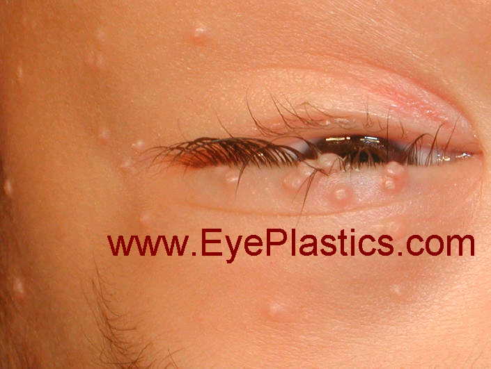 Periocular and eyelid molluscum contagiosum — small umbilicated papules