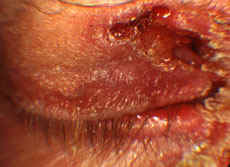 Squamous cell carcinoma skin with indurated keratotic border