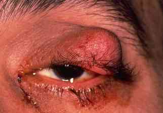 Sebaceous carcinoma upper eyelid with yellow coloration