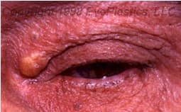 Xanthelasma palpebrarum bilateral medial eyelids