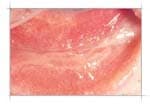 Symblepharon — conjunctival adhesion