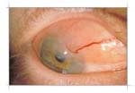 Symblepharon — amniotic membrane repair