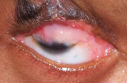 Symblepharon — adhesion between eyelid and globe conjunctiva