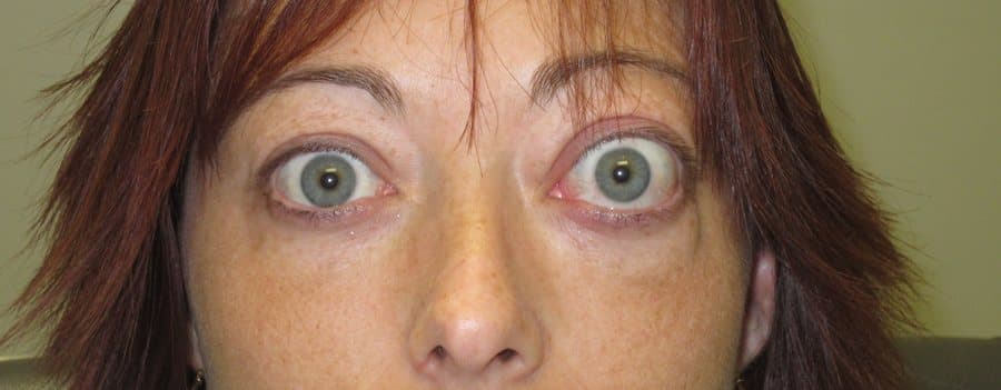 Thyroid eye disease with bilateral eyelid retraction and a staring appearance