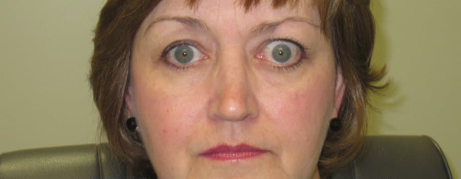 Lower-eyelid retraction in thyroid eye disease, sclera visible below the iris
