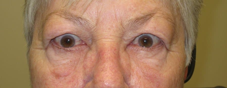 Eyelid retraction from thyroid eye disease in an older patient
