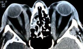 Axial orbital CT showing enlarged extraocular muscles in Graves' orbitopathy