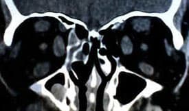 Coronal orbital CT demonstrating extraocular muscle enlargement in thyroid eye disease