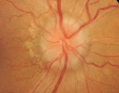 Optic disc edema from compressive optic neuropathy in thyroid eye disease