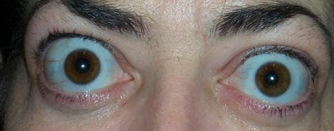 Bilateral proptosis (exophthalmos) in thyroid eye disease