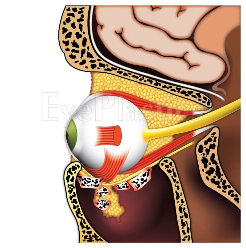 Coronal CT demonstrating orbital floor fracture with herniation of orbital contents into the maxillary sinus