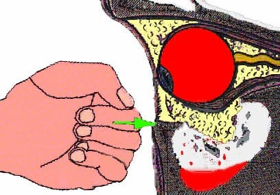 Orbital floor trapdoor fracture in a child with muscle entrapment