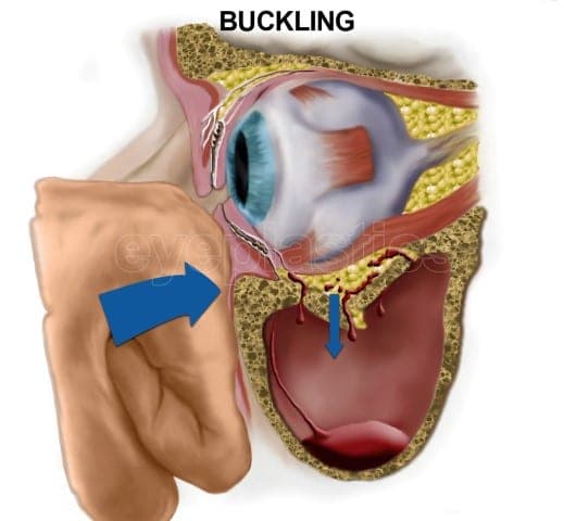 Buckling theory of orbital floor fracture