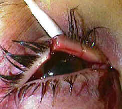 Medial eyelid laceration involving the canaliculus
