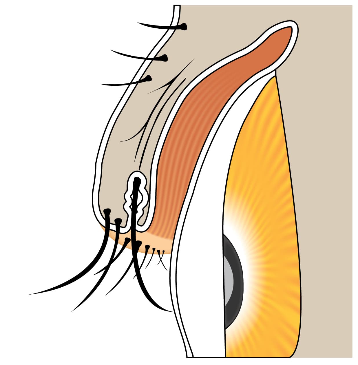 Clinical photograph of distichiasis with an extra row of eyelashes