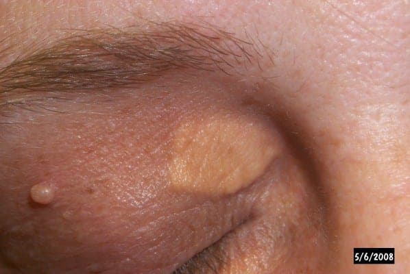 Bilateral xanthelasma of the upper eyelids