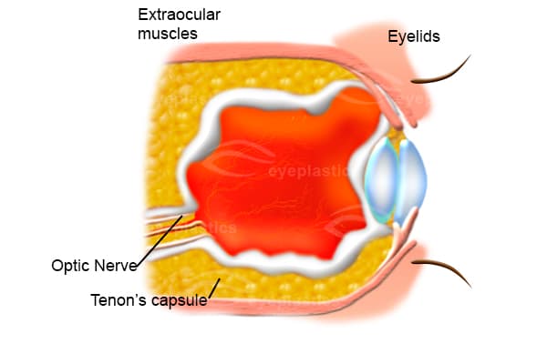 Diagram of the empty anophthalmic socket after the eye is removed