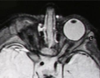 MRI of the orbit demonstrating an anophthalmic socket