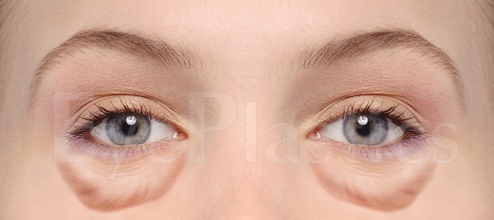 Lower eyelid blepharoplasty before and after