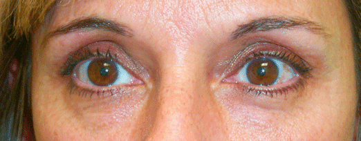 Before — Age 44