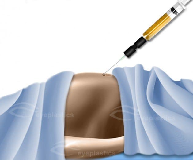 Fat harvested from the abdomen