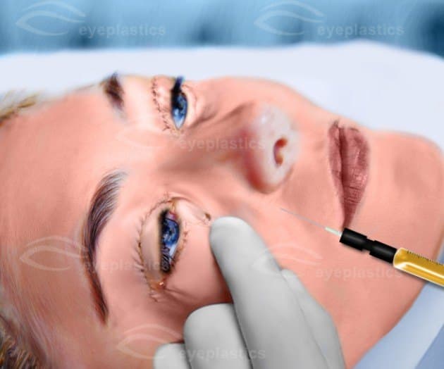 Fat injected into the volume-deficient area
