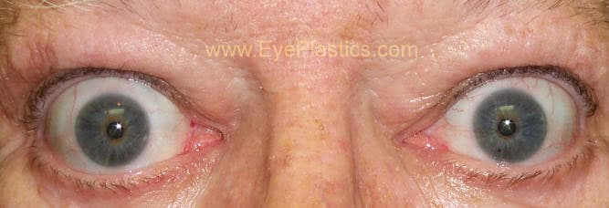 Graves disease showing proptosis of the eyes