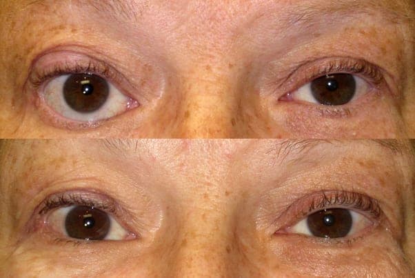 Right lower-eyelid retraction from thyroid eye disease (top), corrected with a posterior spacer graft (bottom)