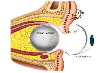 Artificial eye demonstrating natural appearance