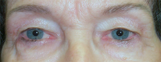 Dermatochalasis — excess upper eyelid skin hooding over the lashes