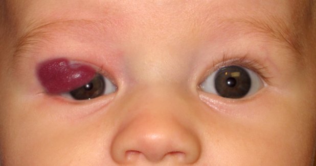 Hemangioma Response to Timolol Over Time — slide 1 of 8