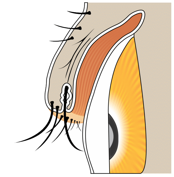 Distichiasis &mdash; second row of eyelashes