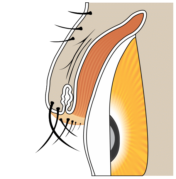 Trichiasis &mdash; lashes pointing toward the eye
