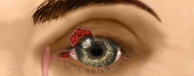 Pentagonal Wedge Resection — Tightening the Lax Upper Eyelid — slide 1 of 4