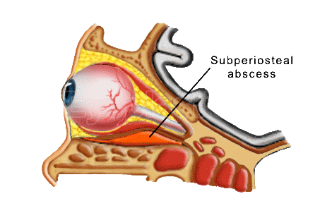 Orbital abscess &mdash; anatomic diagram