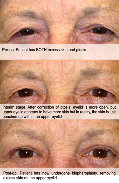 Patient with both ptosis and dermatochalasis — candidates for a combined repair