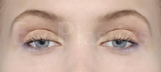 Upper eyelid ptosis — the lid margin drooping over the pupil